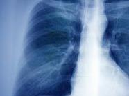 Lungenröntgen (Symbolbild)