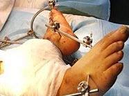 Ärzte kämpfen um das linke Bein von Wanderarbeiter Ma.