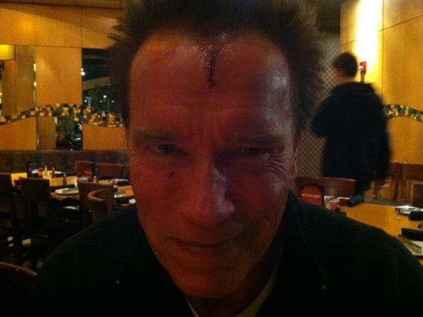 Dieses Bild seiner Verletzung twitterte Arnold Schwarzenegger selbst.