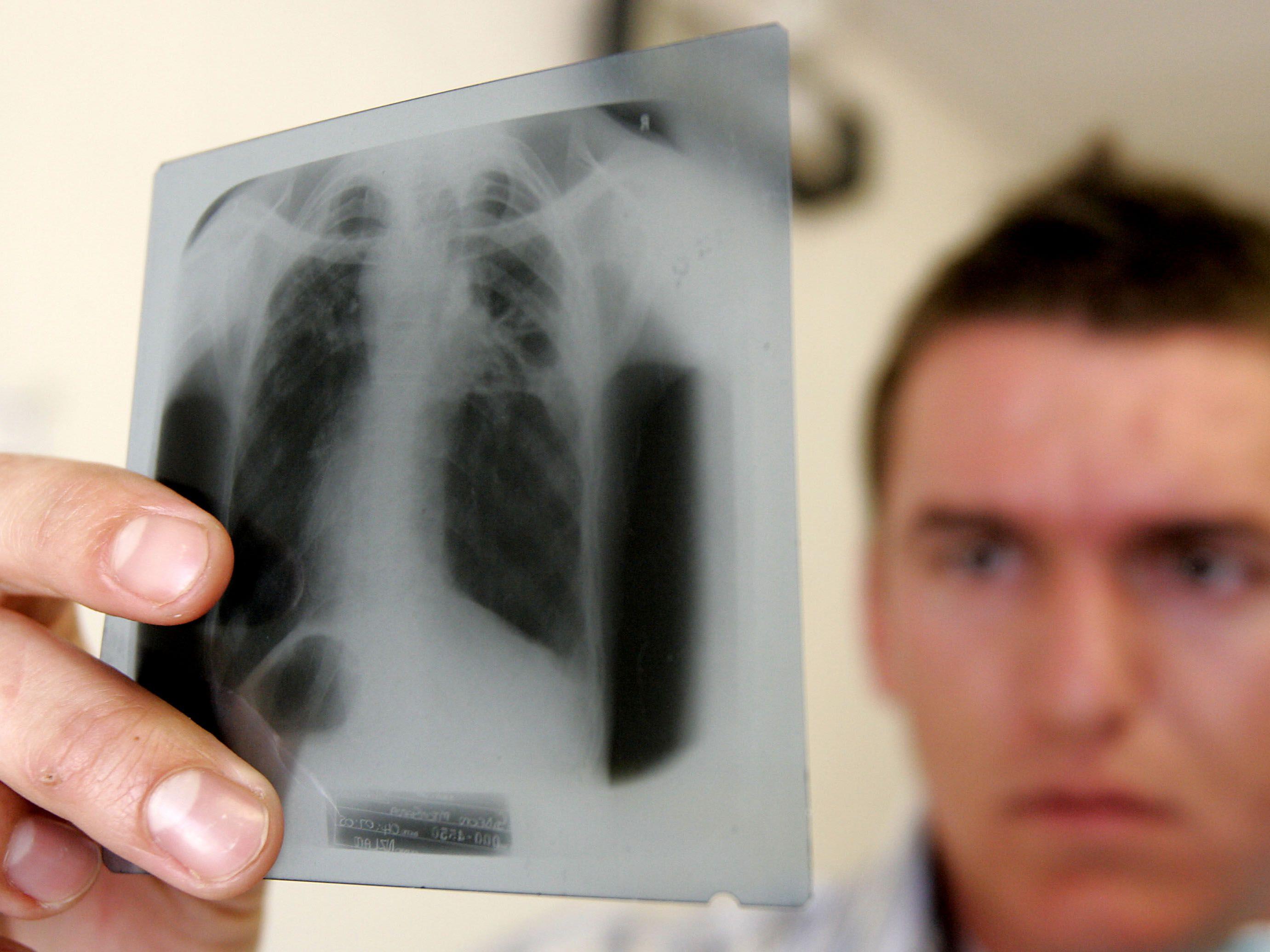 Der Tuberkulose-Bazillus zerstört vor allem die Lungen.