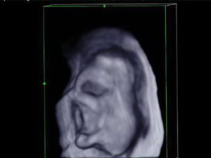 Das Ultraschallbild zeigt das Elefantenbaby am 141. Tag der Trächtigkeit.