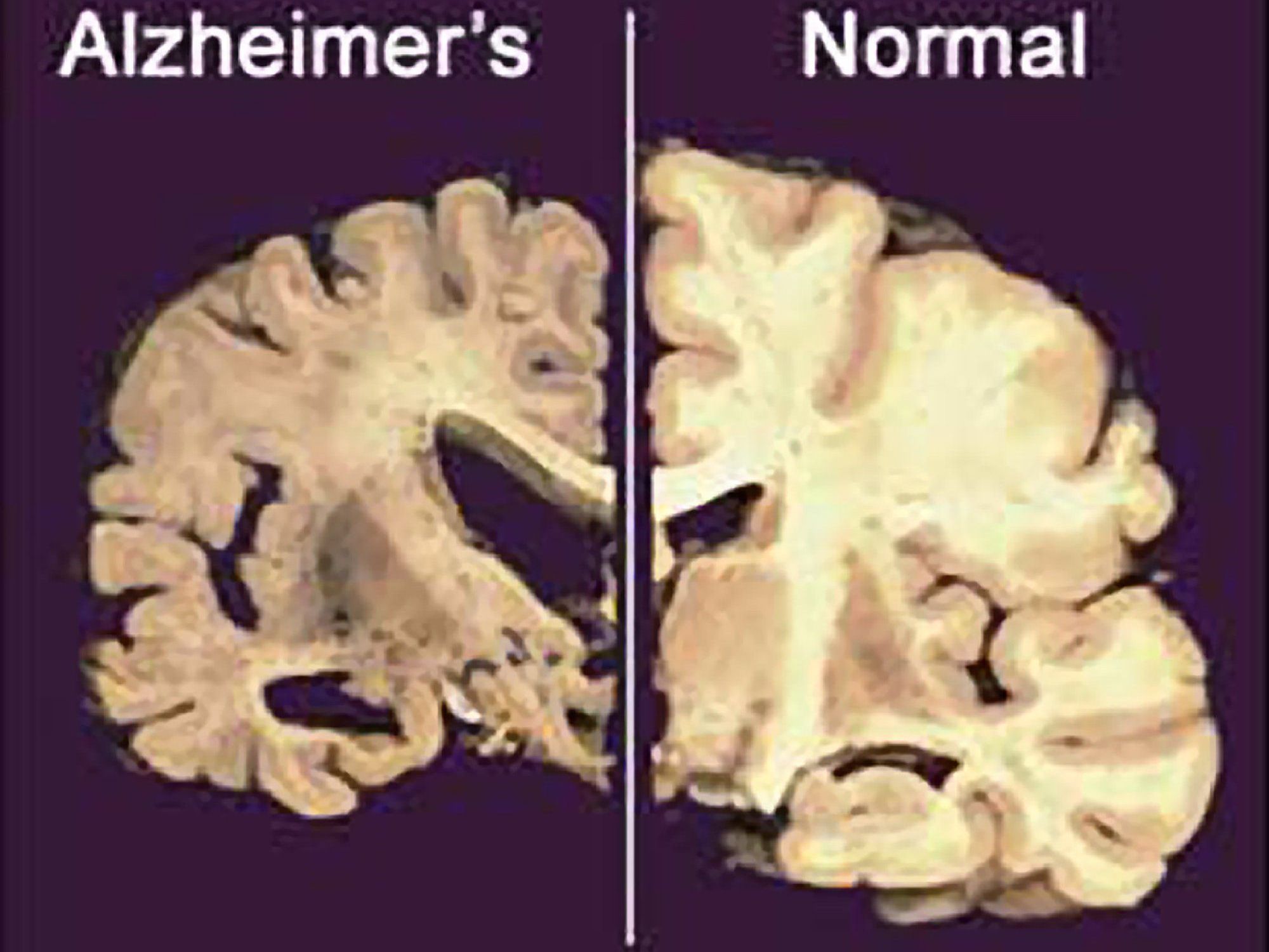 Alzheimer: Kooperationsprojekt gibt Empfehlungen zu der Krankheit ab. Alzheimer: Kooperationsprojekt gibt Empfehlungen zu der Krankheit ab.