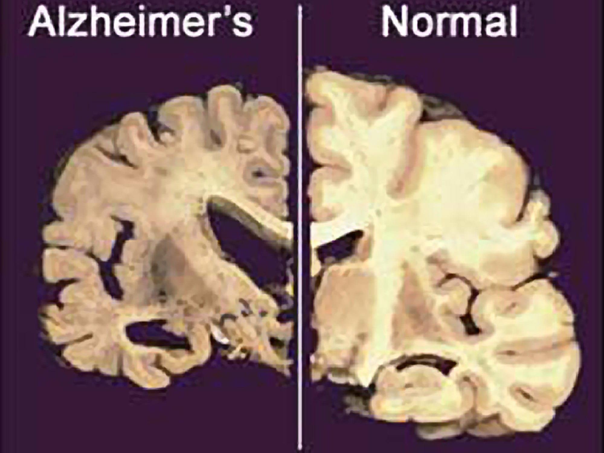 Alzheimer: Kooperationsprojekt gibt Empfehlungen zu der Krankheit ab.