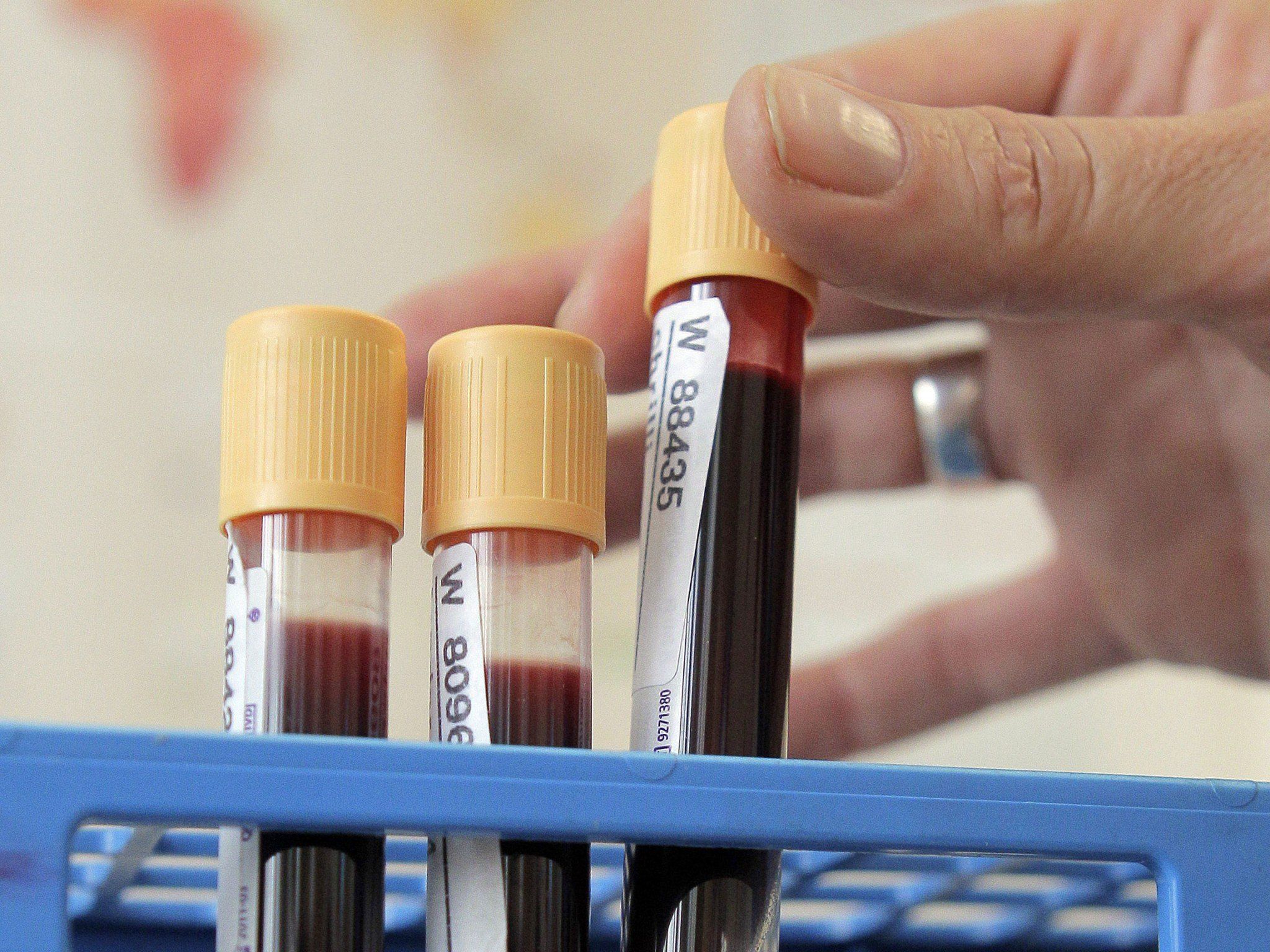 Proteinmarker sollen Erkennung deutlich erleichtern. Proteinmarker sollen Erkennung deutlich erleichtern.