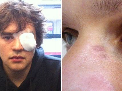 Ein Aktivist soll laut VGT schwere Verletzungen am Auge davon getragen haben (Bild links). Ein Aktivist soll laut VGT schwere Verletzungen am Auge davon getragen haben (Bild links).