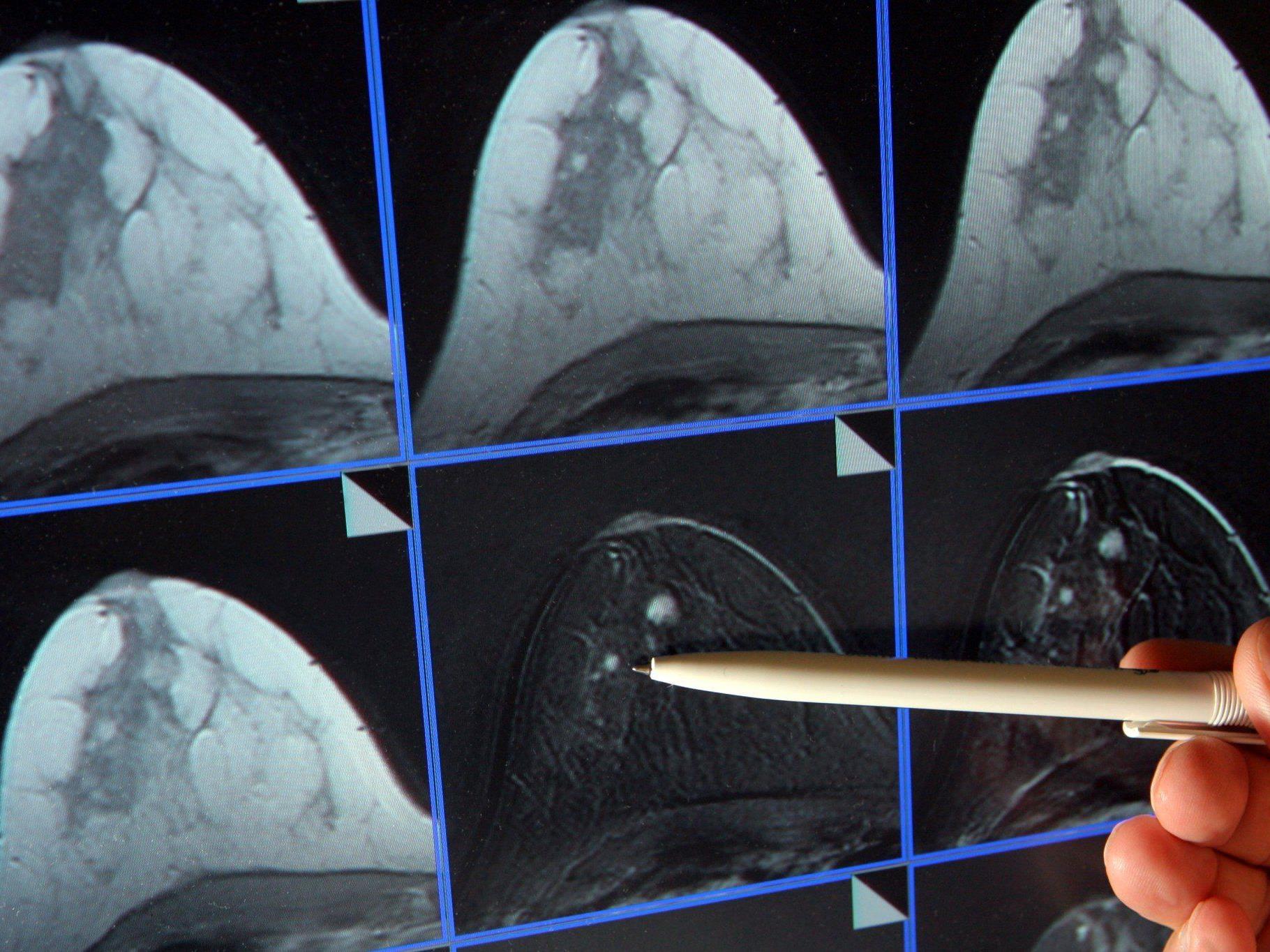 Mammographie zeigt ein winziger Tumor in der Brust einer Patientin.
