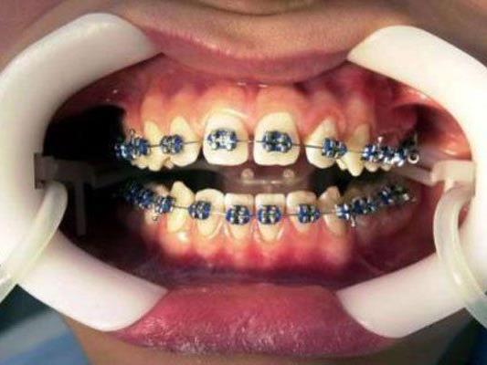 Kinder und Jugendliche sollen kostenlose Zahnspangen erhalten.
