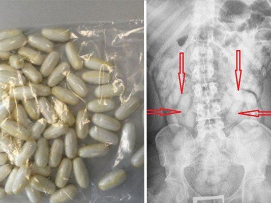 67 Drogenkugeln trug der Kurier in seinem Bauch. 67 Drogenkugeln trug der Kurier in seinem Bauch.