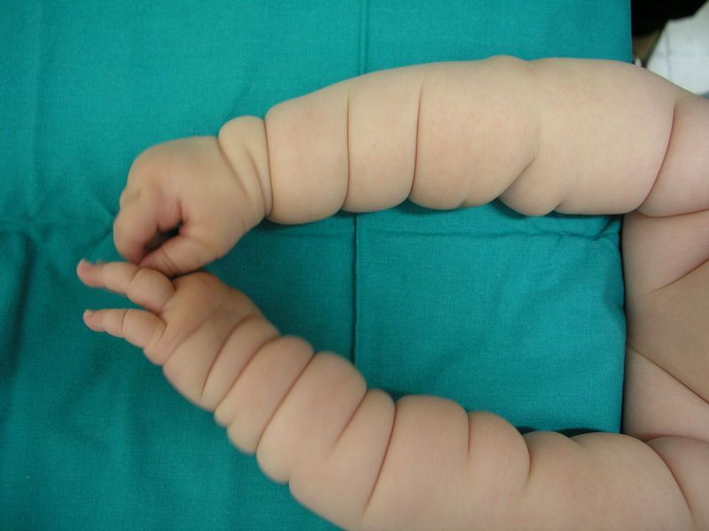 Das Bild zeigt die Arme eines sogenannten “Michelin-Reifen-Babys” mit den charakteristischen Hautfalten. Das Bild zeigt die Arme eines sogenannten “Michelin-Reifen-Babys” mit den charakteristischen Hautfalten.